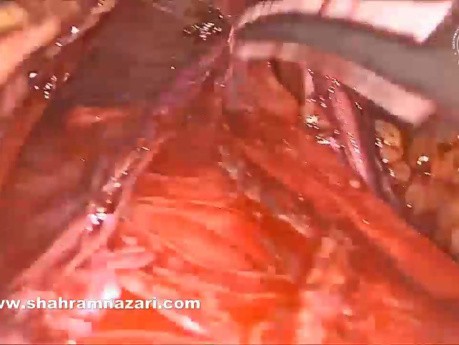 Gastroplastyka Collisa i hiatoplastyka w krótkim przełyku po chirurgii bariatrycznej