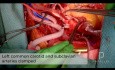 Operacja tętniaka aorty wstępującej i proksymalnej części łuku aorty