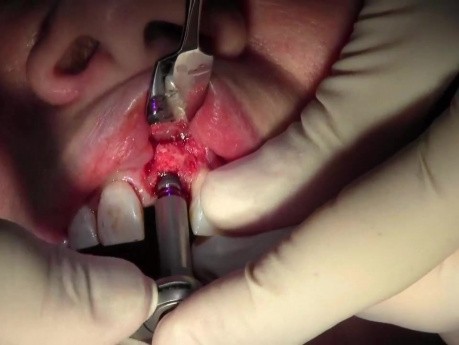 Wszczepienie implantu - #9
