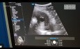 Ablacja Mikrofalowa Adenomiozy Pod Kontrolą Laparoskopii i Ultrasonografii (LUMWA)