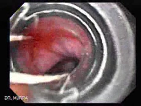 Marskość wątroby - zakładanie opaski na żylak, część 1