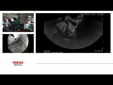 EUS-Guided Transmural Drainage of Post-inflammatory Pancreatic Fluid Collections - Webinar/ Expert Panel