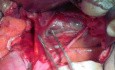 Anatomia miednicy - 3 awaskularne przestrzenie tylne i ich istotność w radykalnym wycięciu macicy