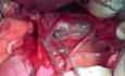 Anatomy of the Pelvis with Surgical Assessment (for Radical Hysterectomy) - Three Posterior Avascular Spaces
