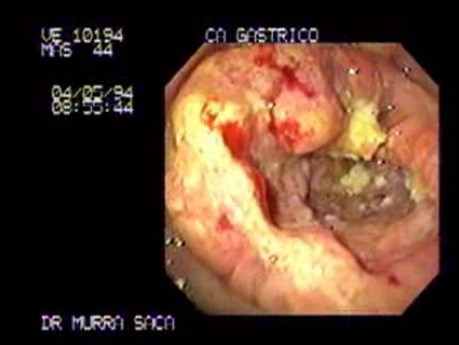 Rak gruczołowy jamy odźwiernikowej