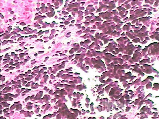 Drobnokomórkowy rak płuc naciekający górną i środkową część przełyku (6 z 7)