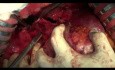Operacja pierwotnego raka wątroby
