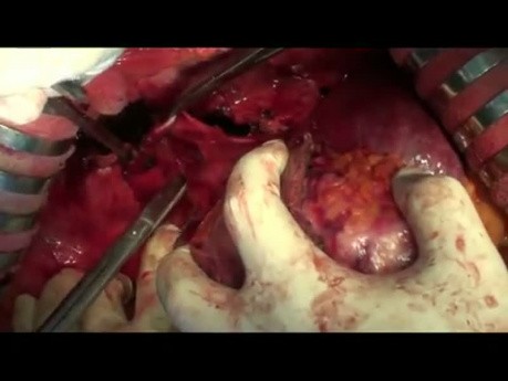 Operacja pierwotnego raka wątroby