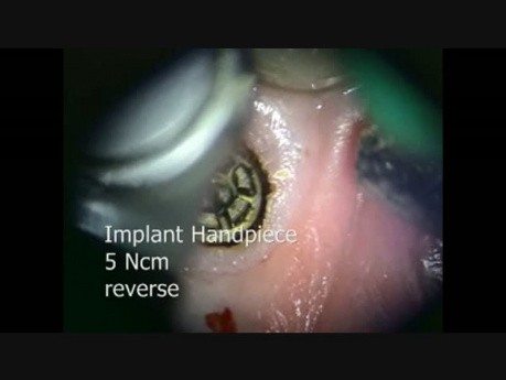 Usuwanie złamanego łącznika implantu