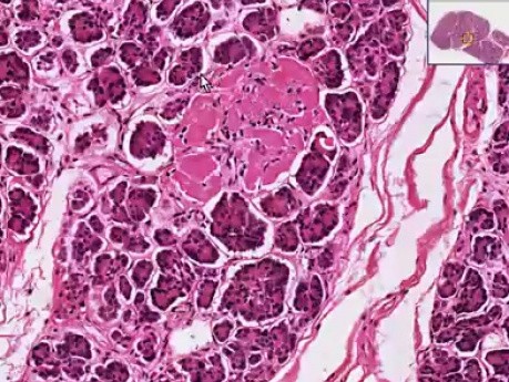 Wysepki trzustkowe po hialinizacji - histopatologia trzustki