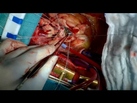 Operacja tętniaka korzenia aorty wstępującej z niedomykalnością zastawki aortalnej z użyciem protezy naczyniowej