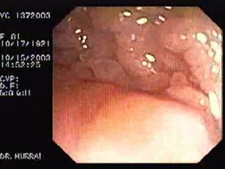 Gruczolak cewkowo - kosmkowy - endoskopia (2 z 28)