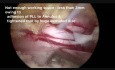 Endoskopowa discektomia 