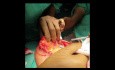Operacja oszczędzająca pierś  (blokowa mastopeksja) w raku piersi 