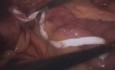 Operacja Gastric Bypass - laparoskopia