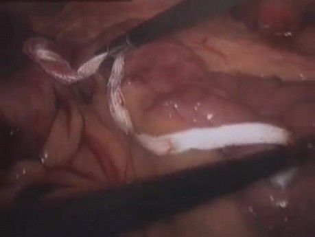 Operacja Gastric Bypass - laparoskopia