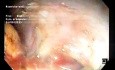 Dissection Sous-Muqueuse d'un Large LST-G de Type Mixte de 11 x 5 cm - Patient avec Syndrome de Fragilité