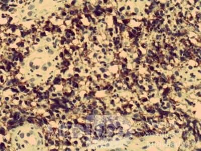 Chłoniak nieziarniczy z komórek B typu MALT  (5 z 7)