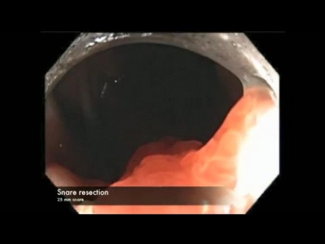 Kolonoskopia: resekcja olbrzymiego polipa okrężnicy