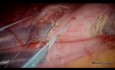 Laparoskopowa resekcja dwóch guzów żołądka