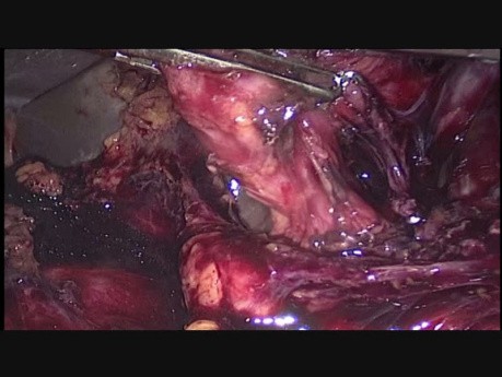 Trudna cholecystektomia laparoskopowa