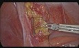 Appendektomia laparoskopowa z powodu ostrego zapalenia wyrostka robaczkowego o etiologii pasożytniczej