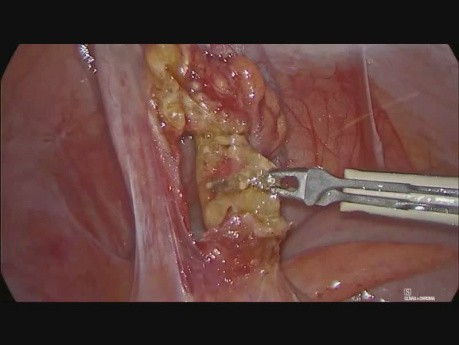 Appendektomia laparoskopowa z powodu ostrego zapalenia wyrostka robaczkowego o etiologii pasożytniczej
