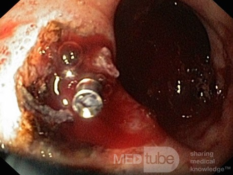 Endoskopowe opanowanie krwawienia z owrzodzenia dwunastnicy - 2/2