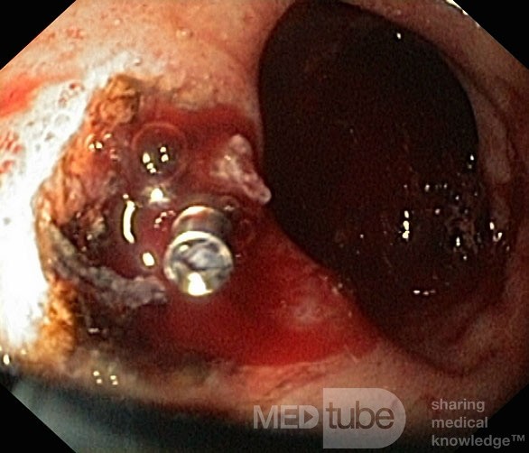 Endoskopowe opanowanie krwawienia z owrzodzenia dwunastnicy - 2/2