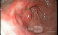 Endoskopia - gastropatia nadżerkowa