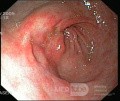 Endoskopia - gastropatia nadżerkowa
