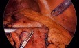 Gastrectomie Subtotale par Laparoscopie pour la Prise en Charge des Polypes Hémorragiques