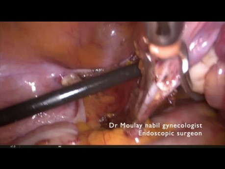 Całkowita laparoskopowa histerektomia- pomoc dla rezydentów