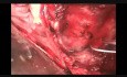 Chirurgiczne leczenie rozwarstwienia aorty typu A