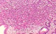 Mały gruczolakorak żołądka typu rozlanego raka żołądka z komórkami sygnetowatymi (4 z 19)