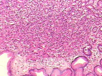 Mały gruczolakorak żołądka typu rozlanego raka żołądka z komórkami sygnetowatymi (4 z 19)