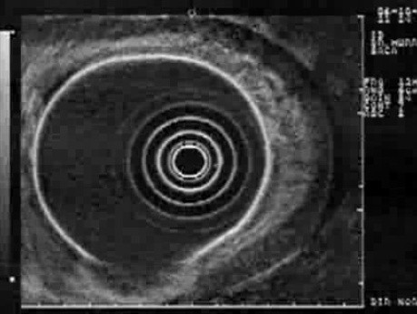 Rak włóknisty żołądka - ultrasonografia endoskopowa (10 z 15)