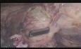Miomektomia laparoskopowa mięśniaka przedniej ściany macicy