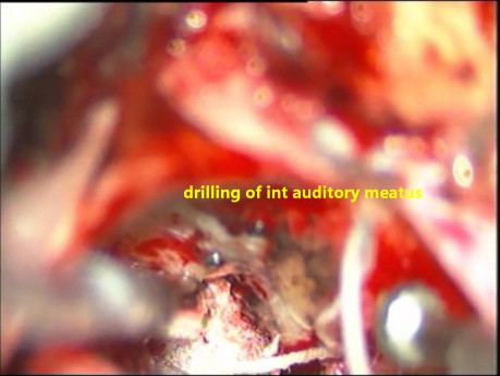 Mikrochirurgiczne usunięcie osłoniaka nerwu słuchowego z zachowaniem nerwu twarzowego
