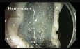 Kolonoskopia - okrężnica poprzeczna - ogromny uszypułowany polip - EMR