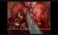 Laparoskopowa appendektomia