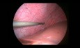 Endometrioza przepony- laparoskopia
