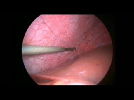 Endometrioza przepony- laparoskopia