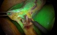 Laparoskopowa cholecystektomia z śródoperacyjną cholangiografią przy użyciu zieleni indocyjaninowej