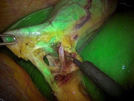 Laparoskopowa cholecystektomia z śródoperacyjną cholangiografią przy użyciu zieleni indocyjaninowej