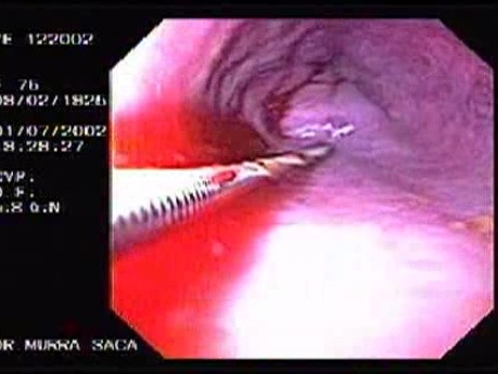 Krwotok - podwiązywanie żylaków przełyku (gumowa opaska) - trzecia skleroterapia celowana w dużą żyłę