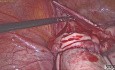 Laparoskopowe usunięcie dużej wielopęcherzykowej torbieli jajnika