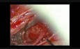 Mikrochirurgiczne usunięcie guza kanału kręgowego o typie oponiaka