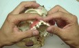 Przeszczep kości - odseparowanie okostnej