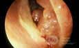 Papiloma invertido del seno esfenoidal